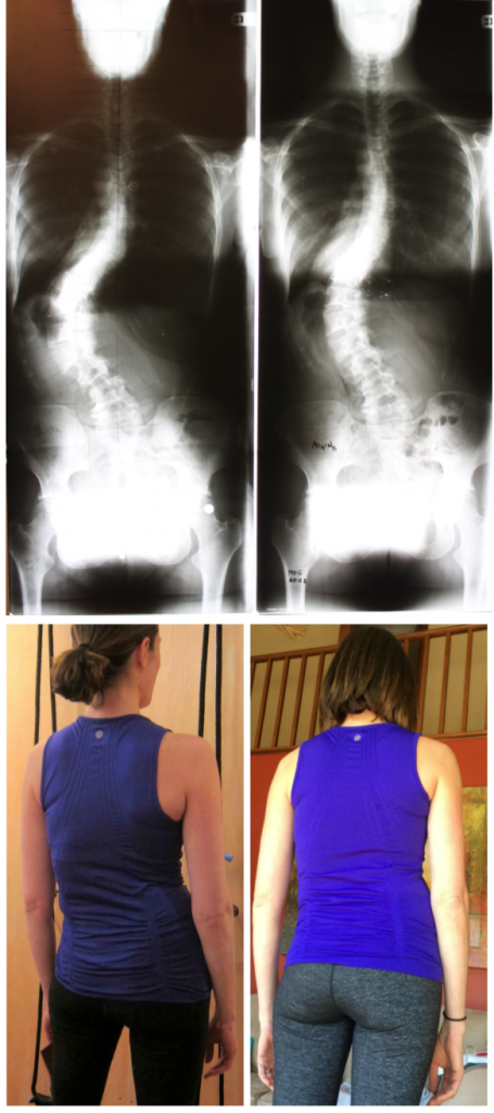 Mandy xray and photos of back comp